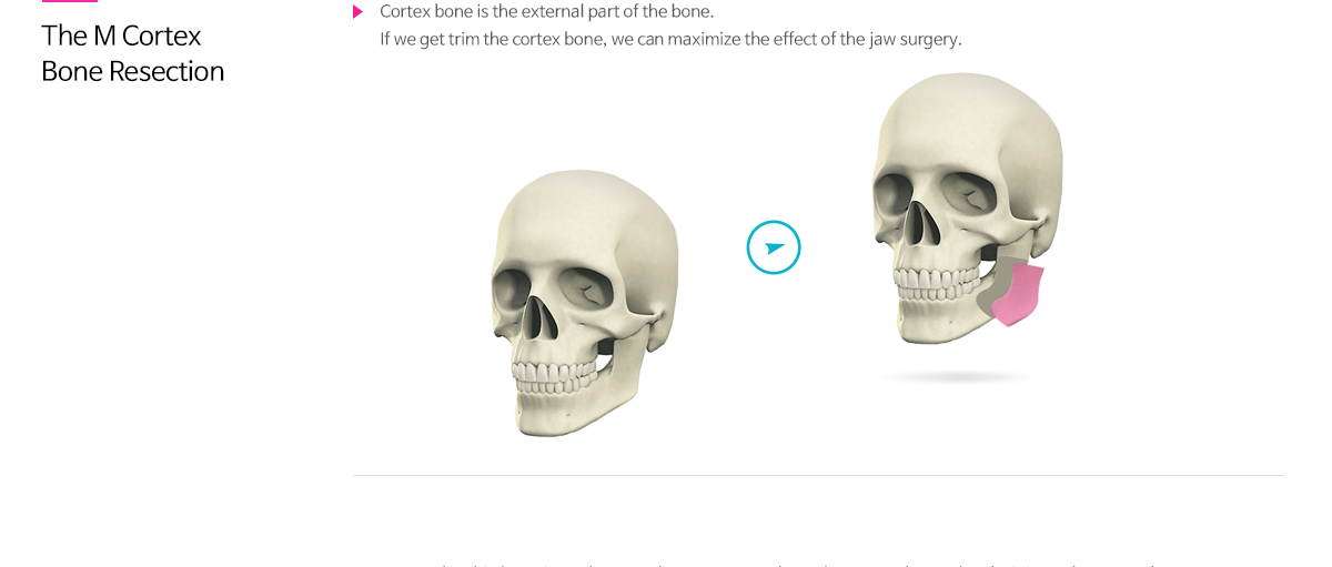 피질절골술 - 세 겹으로 된 뼈 구조 중 가장 바깥쪽 한층 외피질을 절골하는 수술로써 사각턱 교정 시 정면 효과를 극대화 할 수 있는 수술입니다.